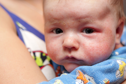 Remèdes maison naturels pour l’eczéma des bébés et des enfants